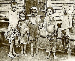 Image of the children suffering from famine